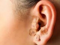 Auriculoterapia